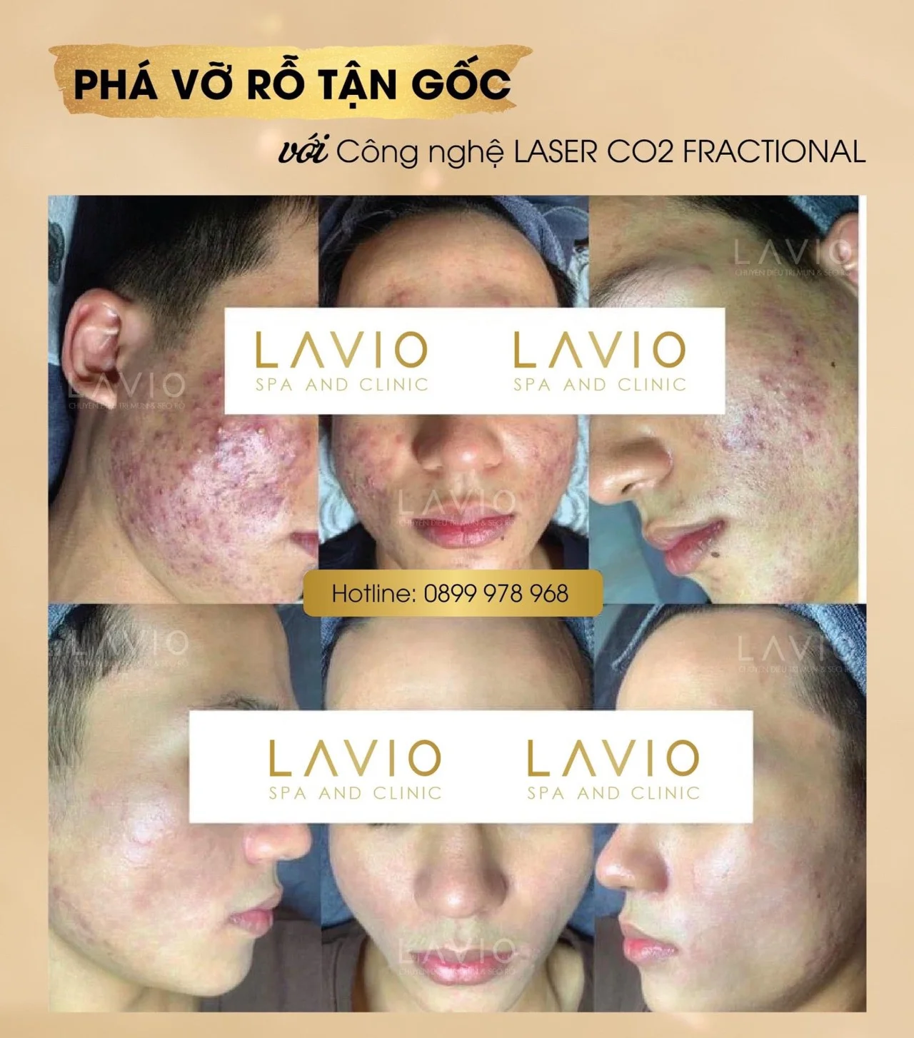 LAVIO Spa & Clinic Cần Thơ trị sẹo uy tín
